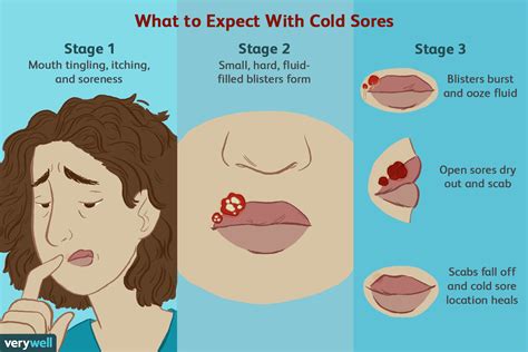 cold sore pics stages|cold sore outbreaks getting worse.